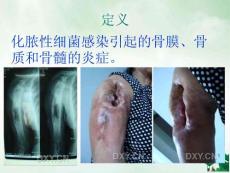 骨髓炎演示文稿课件