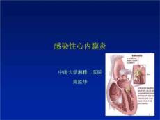 感染心内膜炎-课件