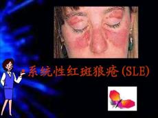 系统性红斑狼疮 课件