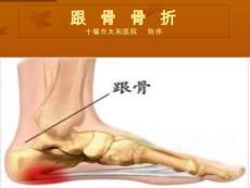 跟骨骨折护理课件