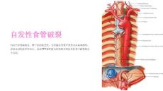 《自发性食管破裂》课件