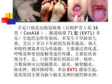 肠道病毒EV71感染诊疗指南.ppt