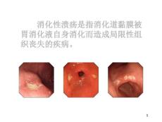 小儿消化性溃疡课件.ppt