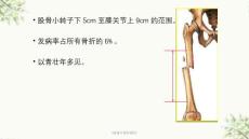 股骨干骨折骨折课件.ppt