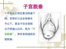 子宫脱垂.ppt