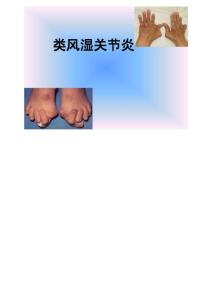 类风湿性关节炎