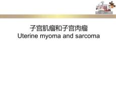 子宫肌瘤肉瘤