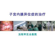 子宫内膜异位症治疗