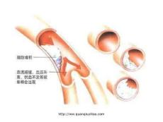 关注高血脂高血脂课件.ppt