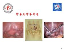 卵巢与卵巢肿瘤PPT课件.ppt