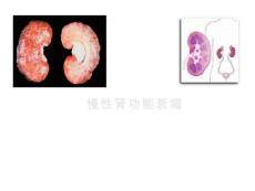 慢性肾功能衰竭CRF