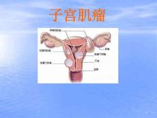 子宫肌瘤课件