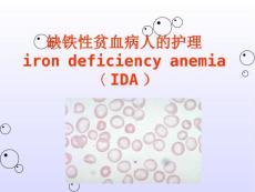 缺铁性贫血
