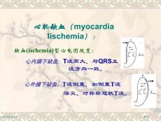 心肌缺血心电图