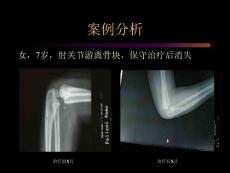 医学--化脓性关节炎课件