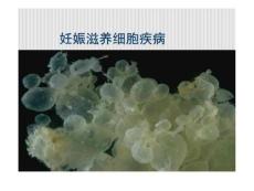 妊娠滋养细胞疾病
