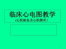 心电图心肌缺血和心肌梗死