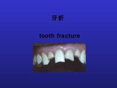 【口腔医学】牙折的病因及治疗方法PPT【75页】