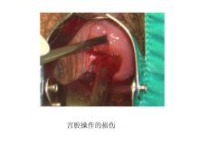 慢性宫颈炎