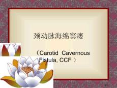 颈动脉海绵窦瘘培训课件