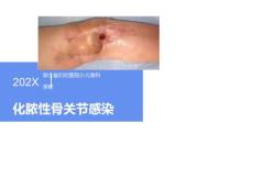 化脓性关节炎查房