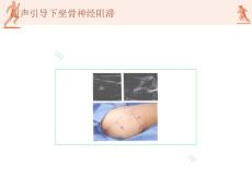 坐骨神经阻滞xjq