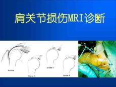肩关节损伤MRI诊断