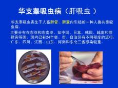 华支睾吸虫病教学文案