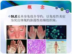 系统性红斑狼疮
