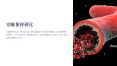 动脉粥样硬化课件