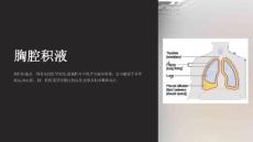 《胸腔积液》课件