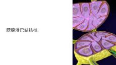《腮腺淋巴结结核》课件