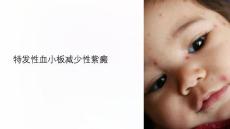 特发性血小板减少性紫癜课件