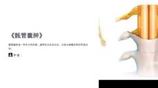 《骶管囊肿》课件