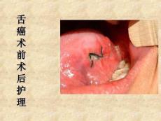 舌癌术前术后护理
