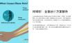 《网球肘治疗方法》课件
