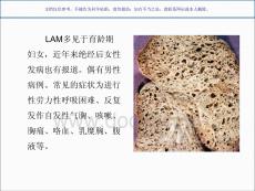 淋巴管肌瘤病的肺部CT表现