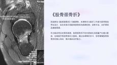 《股骨颈骨折》课件