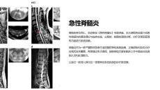 《急性脊髓炎》课件