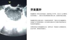 《卵巢囊肿》课件