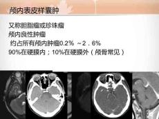 颅骨表皮样囊肿治疗与跟踪观察培训课件