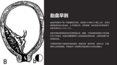 《胎盘早剥》课件