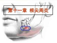 根尖周炎课件