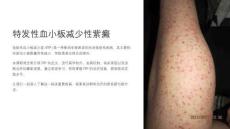 《特发性血小板减少性紫癜》课件