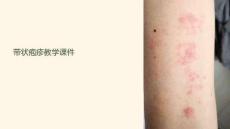 帶狀皰疹教學課件