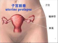 子宮脫垂(共16張PPT)