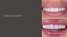 貼面修復(fù)培訓(xùn)課件