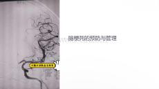 腦梗培訓(xùn)課件