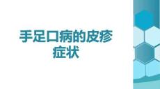 手足口病的皮疹癥狀