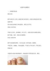 灰指甲初期图片